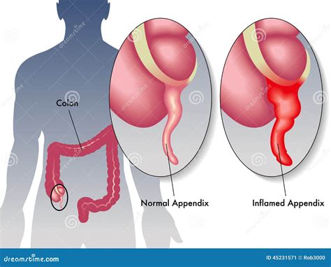 Appendicitis Stock Vector Image