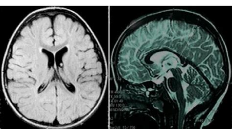 RMN cerebral A Corte Axial Asimetría ventricular sutil de predominio