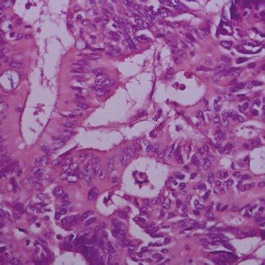 Proliferative growth involving the mucocutaneous junction of the... | Download Scientific Diagram