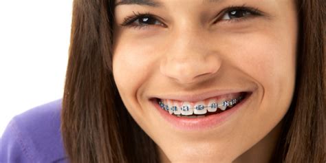 Do Braces Stain Your Teeth? Reasons And Treatment - Brussels Morning ...