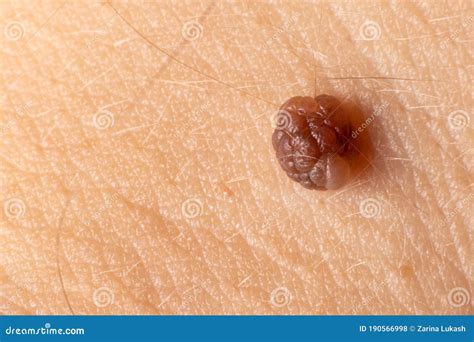 Mole Birthmark Nevus Macro Photo On Human Skin Close Up Stock