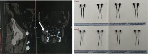 Groin Lymphorrhea After Catheter Ablation Of Atrial Fibrillation A Case Report Heartrhythm