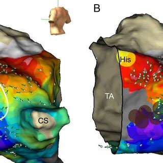 The Activation Vector Map Of The Kochs Triangle During Sinus Rhythm In