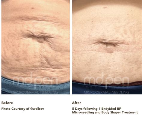 How Microneedling Can Treat Stretch Marks Mdpen