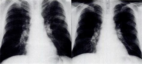 Chronic Cavitary Pneumocystis Carinii Pneumonia In A Patient With Aids Chest