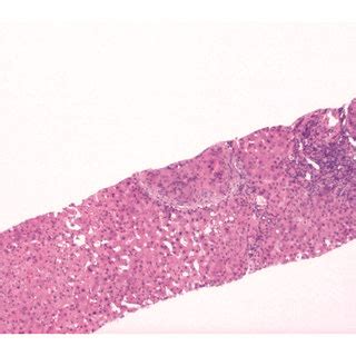 Liver Biopsy A Liver H E X Low Power View Showing Liver