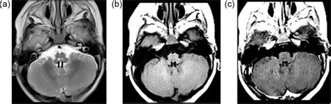 Axial T2 Showing Focal T2 Hyperintense Signal At The Posterior Medulla