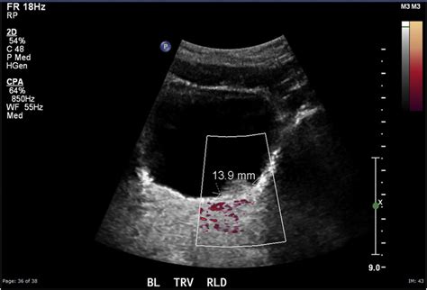 Ultrasound Image Of Lesion Within Urinary Bladder Download Scientific Diagram