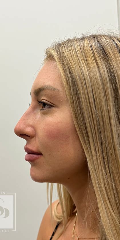 Patient 12006 Non Surgical Nose Job Before And After Photos Brea Med