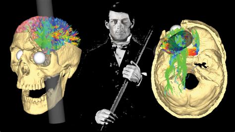 Phineas Gage The Most Famous Brain Injury Survivor In History