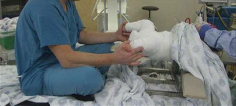 Applying Spica Cast