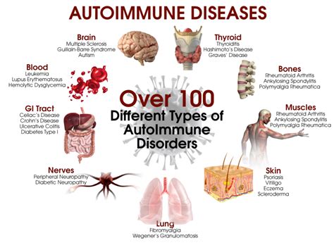 How To Cure Autoimmune Disease - Trackreply4