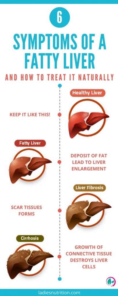 6 Symptoms Of a Fatty Liver And How To Treat It Naturally