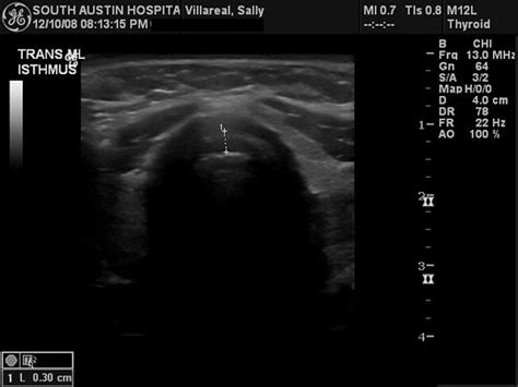 Thyroid Ultrasound: Thyroid Ultrasound Results Time