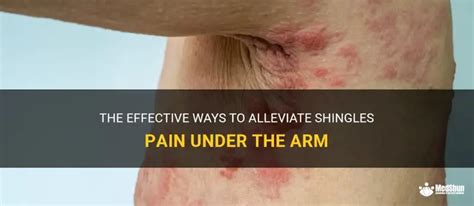 The Effective Ways To Alleviate Shingles Pain Under The Arm | MedShun
