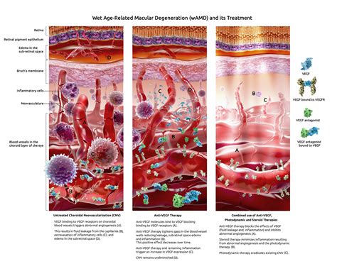 Triptych Illustration on Wet Age-Related Macular Degeneration and its Treatment - Geras ...