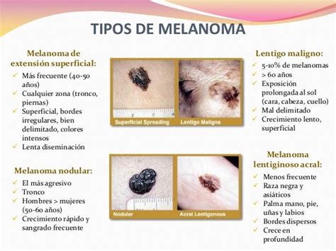 Tratamiento Del Melanoma Cutáneo