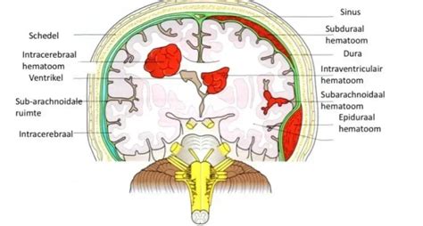 Stroke Cva Types Of Brain Injury Brain Disorders Braininjury