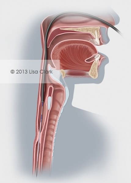 Esophageal Stricture – Artists' Blogs :: Medical Illustration Sourcebook