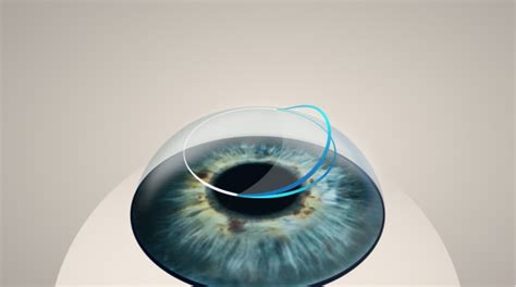 LASIK Bladeless Vision Correction Cohen Eye Institute