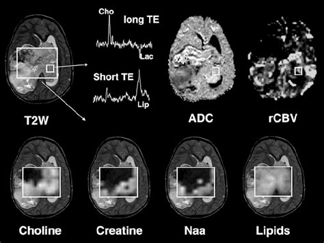 Conventional T2 Weighted Image T2w Diffusion Adc And Hemodynamic