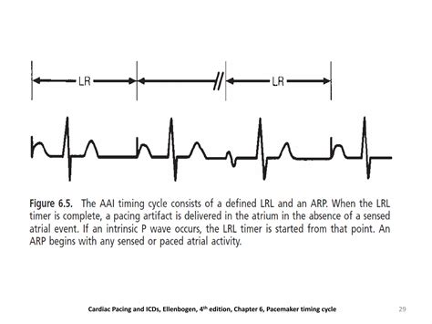 Evaluation And Management Of Pacemaker Malfunction Ppt