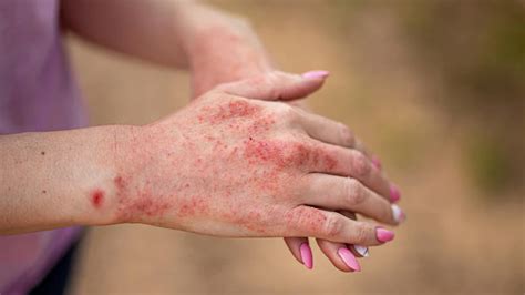 Skin Rashes Symptoms Causes And 9 Ayurvedic Remedies To Treat Them