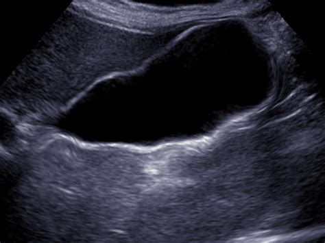 [figure Acalculous Cholecystitis Image Courtesy Dr Chaigasame] Statpearls Ncbi Bookshelf