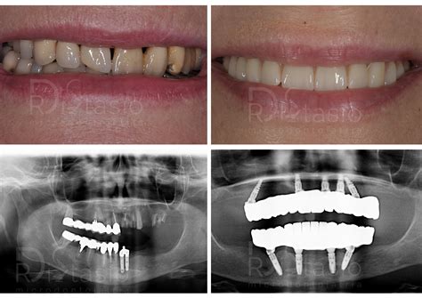 Prima E Dopo Implantologia Foggia Studio Dentistico Di Stasio