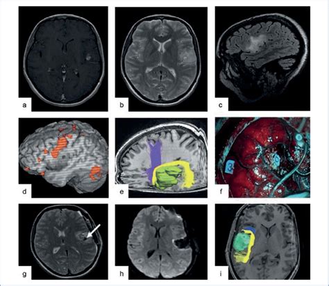 Magnetic Resonance Imaging Of The Brain Of The Patient A Download Scientific Diagram