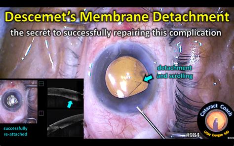 Descemets Membrane Detachment Cataract Coach