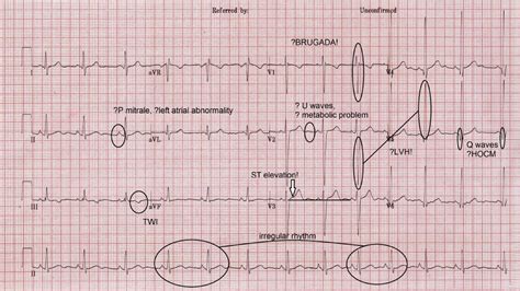 Pathological Q Waves Ecg / Cariology: W1D1AM at Wake Forest University ...