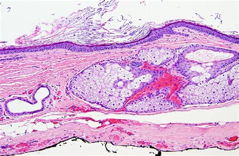 File:Germ cell tumor 01.jpg - Embryology