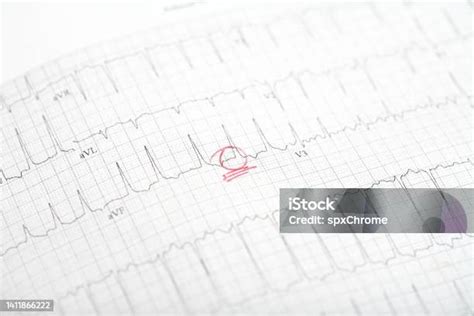 Ekg Atrial Fibrillation Stock Photo - Download Image Now - Heart - Internal Organ, Atrial ...