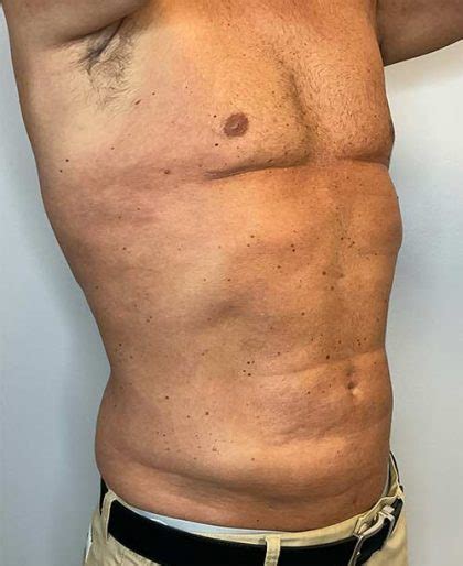 Patient Renuvion Skin Tightening Before And After Photos Raleigh