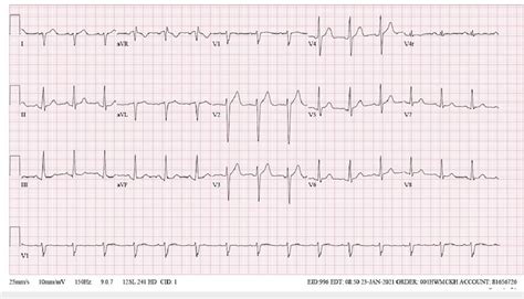 Ekg Showed Sinus Tachycardia With Right Bundle Branch Block Ekg