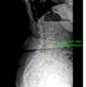 Case Study L And L Laminectomy With Neurolysis Complete