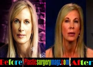 Beth Holloway Plastic Surgery: From Tragedy to Transformation? - Plastic Surgery Magazine