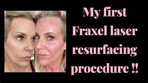 Fraxel Laser Resurfacing Over Years Old Youtube