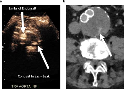 Step By Step Approach To Management Of Type Ii Endoleaks Techniques