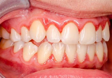 Treating Severe Gingivitis With Minor Perio Surgery Dallas Tx