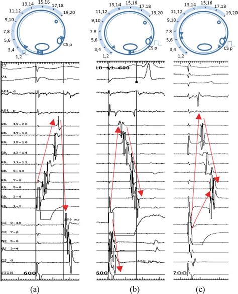 Atrial Flutter Diagnosis And Management Strategies IntechOpen