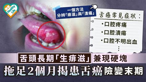 舌癌｜舌頭長期「生痱滋」兼現硬塊 拖足2個月揭患舌癌險變末期 晴報 健康 腫瘤及癌症 D210731