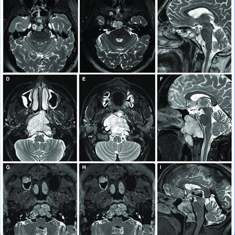 A C Case Preoperative Axial A B And Sagittal C T Weighted Mri