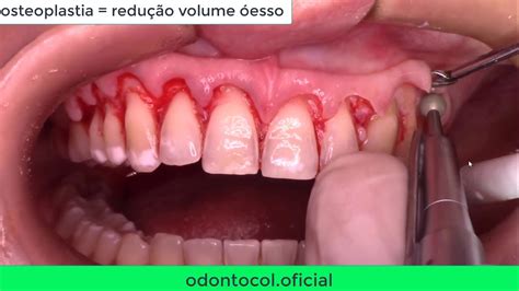 Cirurgia Periodontal Osteoplastia E Osteotomia No Aumento De Coroa