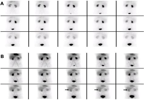 Dynamic Images Of M Tc Ec Renal Scintigraphy In Posterior A And