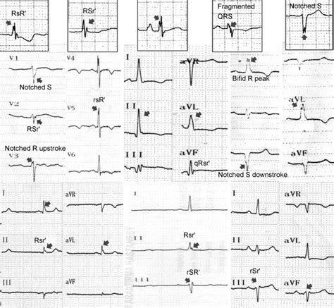 Rn Qrs Complex