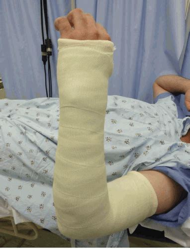 Basics Of Splint And Cast Application Musculoskeletal Key