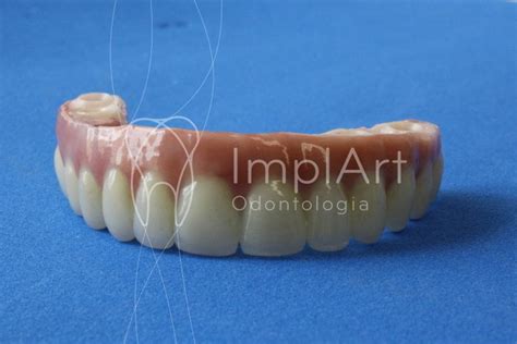 Prótese Protocolo Com Implantes Tipos De Materiais Implart