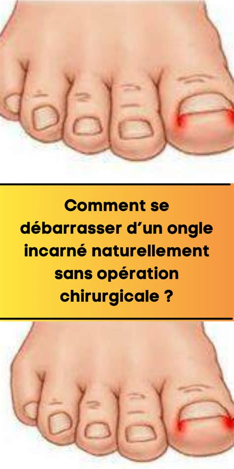 Comment Se D Barrasser Dun Ongle Incarn Naturellement Sans Op Ration